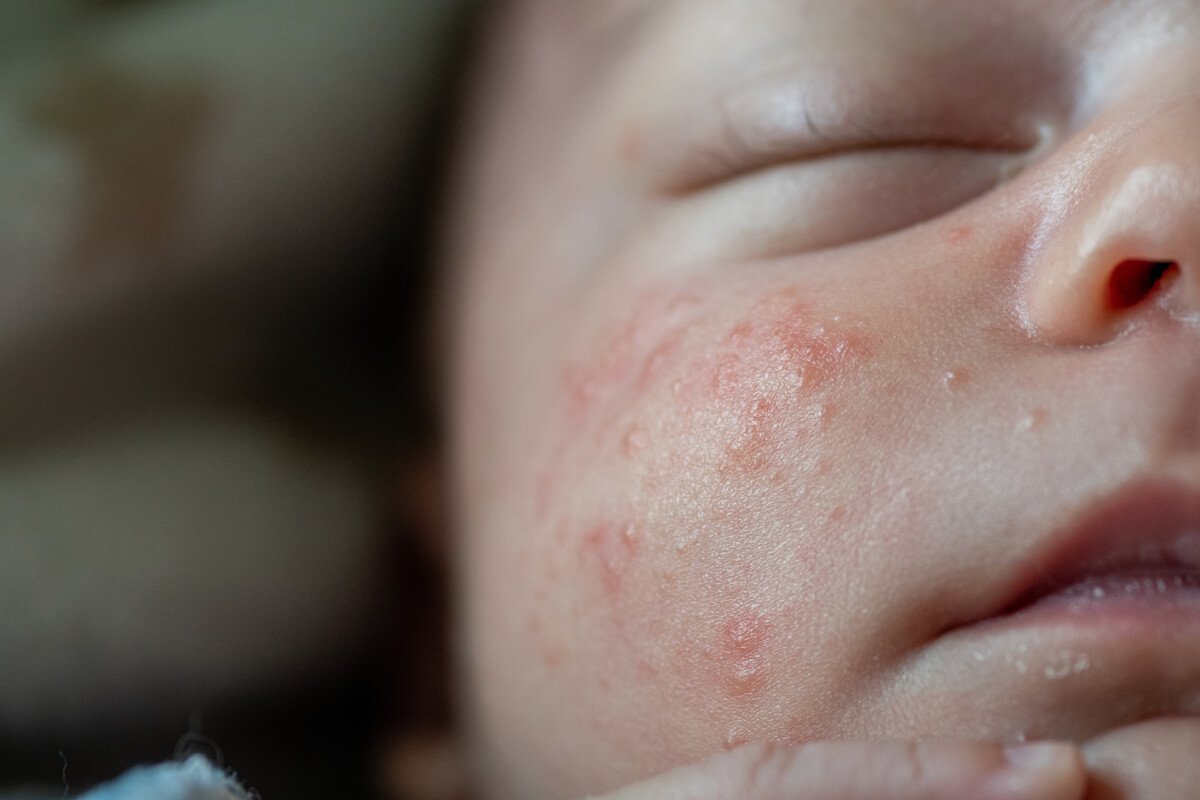 Baby Eczema On Face Treatment