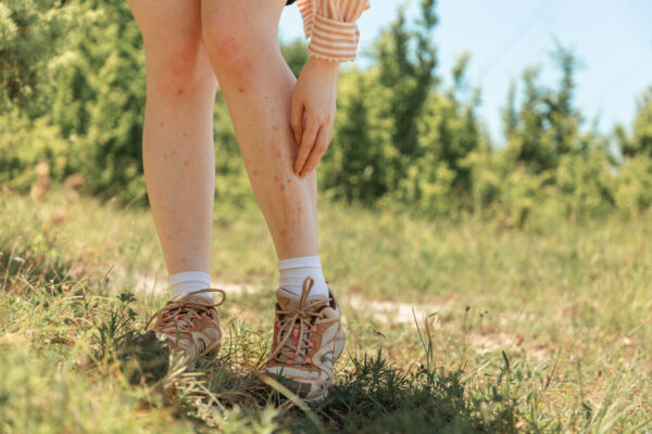 A woman scratches her legs with redness, irritation and pimples from insect bites. Close-up. The concept of protection against mosquitoes, ticks and fleas