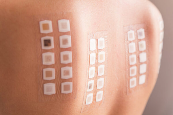 Alergy patch test on the back of a young woman