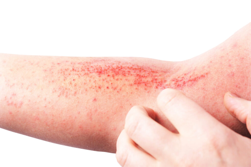 Atopic dermatitis (AD), also known as atopic eczema, is a type o