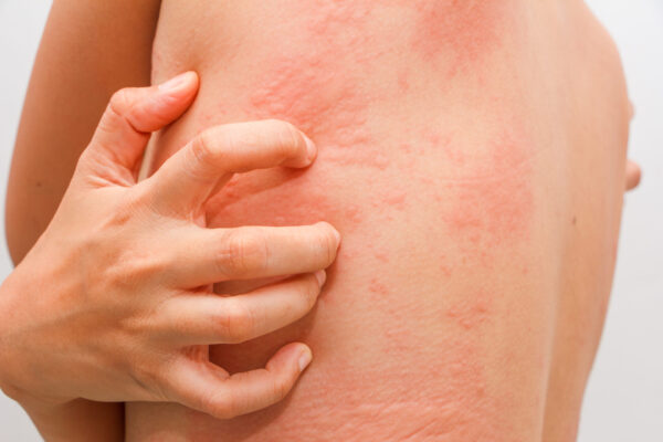 Women with symptoms of itchy urticaria.