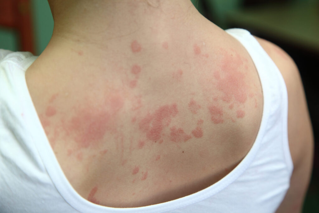 allergic dermatitis. The skin of the girl's back is amazed by dermatitis