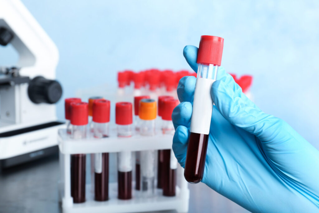 Doctor holding glass tube with blood in laboratory, closeup. Allergy test