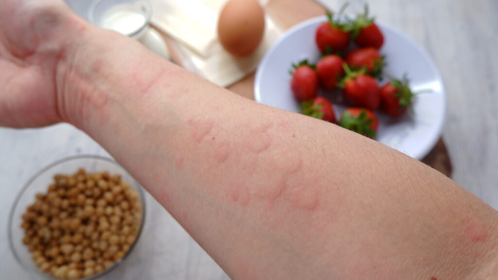 Close up image of arm suffering severe urticaria or hives or kaligata with illustration of allergy trigger foods. Eggs, milk, beans, strawberry, and chesse.