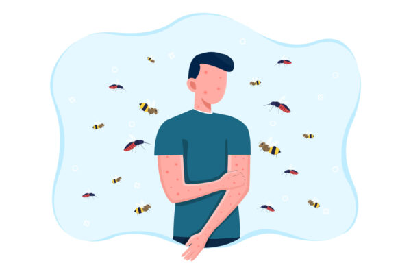 Man suffering from bee allergy. Red and itchy skin. Allergic skin reaction to bees and wasps flying around and stinging. Flat cartoon vector illustration