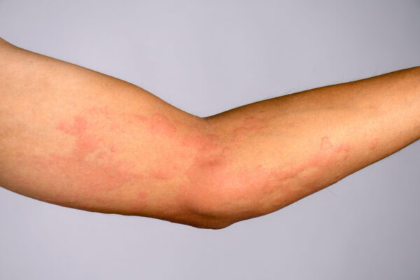 Closeup pictures of the skin are caused by severe hives urticaria.