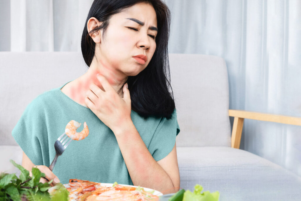 Woman having an allergic reaction to shrimp or seafood. Symptoms include rash, itching, and hives on the skin.