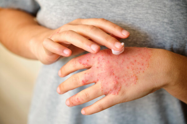 Woman applying ointment or moisturizing cream to the eczema on her hands.
