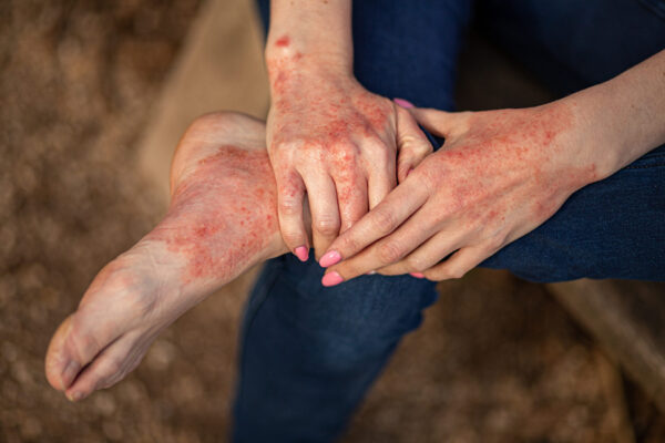Person with eczema dermatitis on hands and feet. Red spots of irritation on the skin.