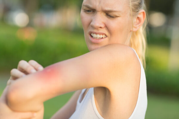 A woman standing outside inspecting the bee sting on her arm