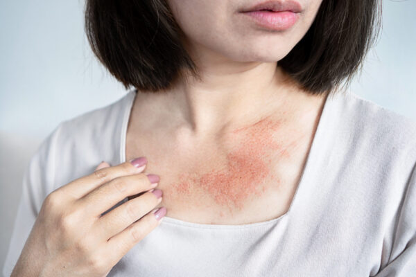 Woman in a white top with chronic hives visible on her chest